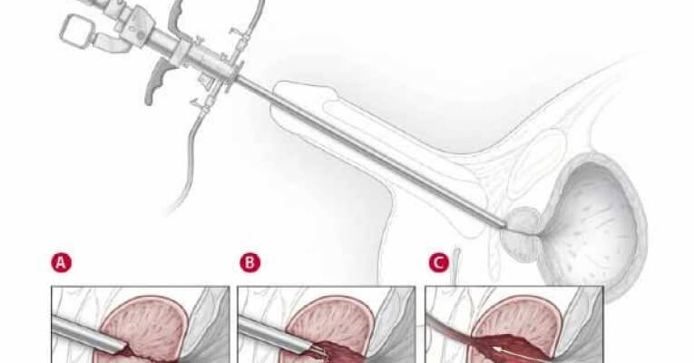 INSTRUMENTAÇÃO CIRÚRGICA EM UROLOGIA ENDOSCÓPICA